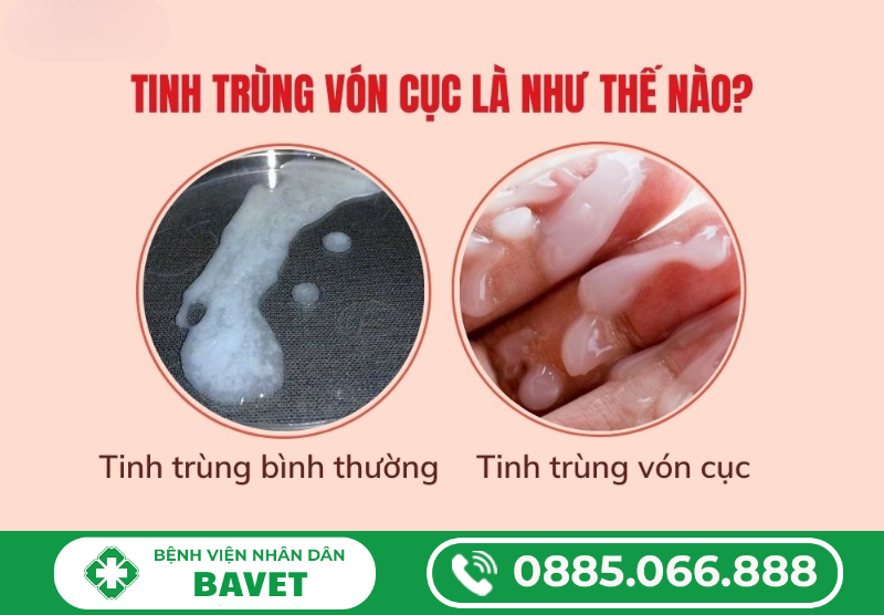 TINH TRÙNG VÓN CỤC LÀ GÌ? CÓ NGUY HIỂM KHÔNG?
