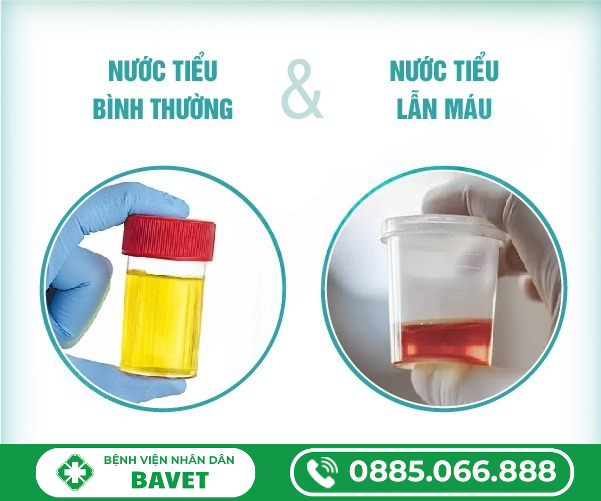 TIỂU RA MÁU – DẤU HIỆU BẤT THƯỜNG CỦA ĐƯỜNG TIẾT NIỆU