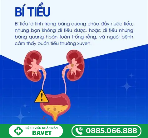 BÍ TIỂU Ở NỮ GIỚI