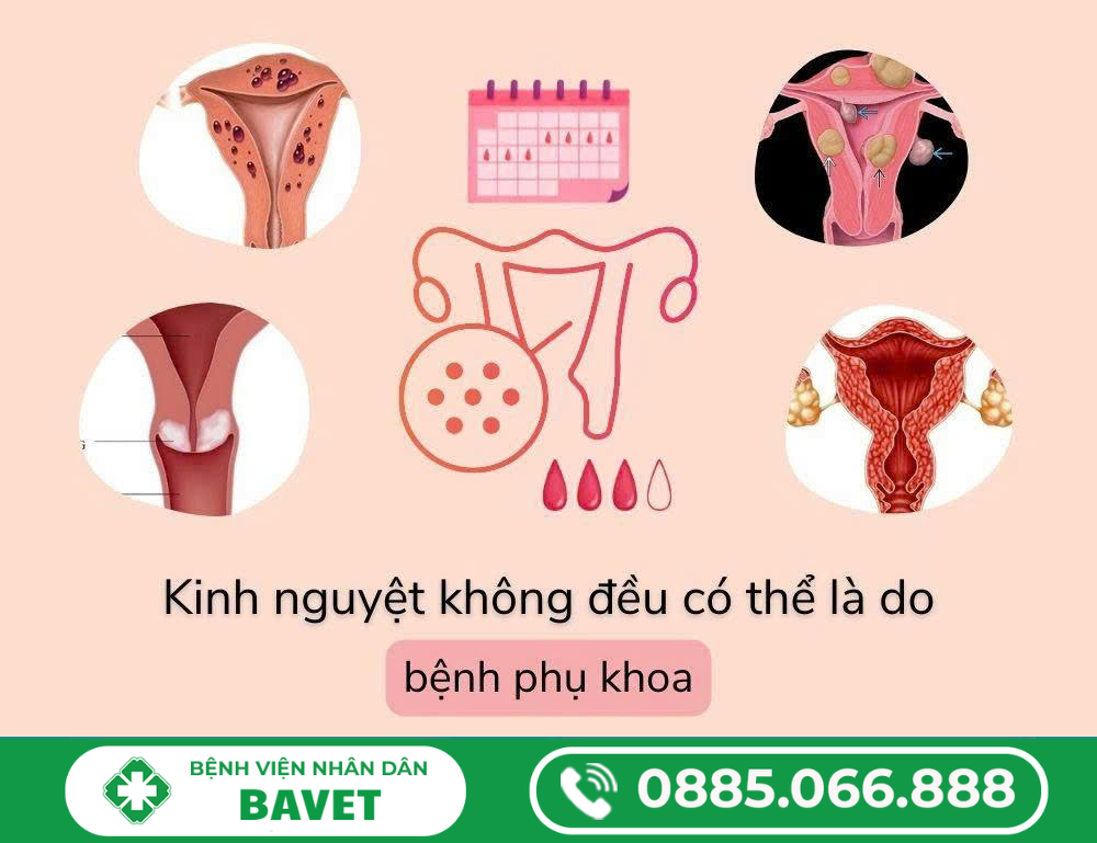 KINH NGUYỆT KHÔNG ĐỀU LÀ GÌ? NGUYÊN NHÂN VÀ CÁCH KHẮC PHỤC